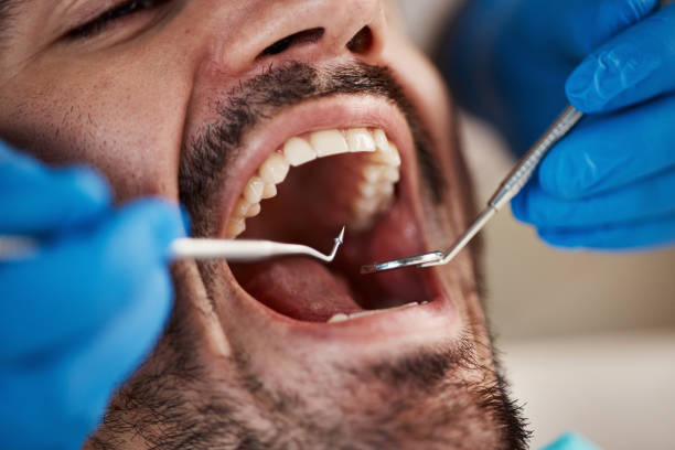 Best Emergency Wisdom Teeth Removal in Jamestown, CA